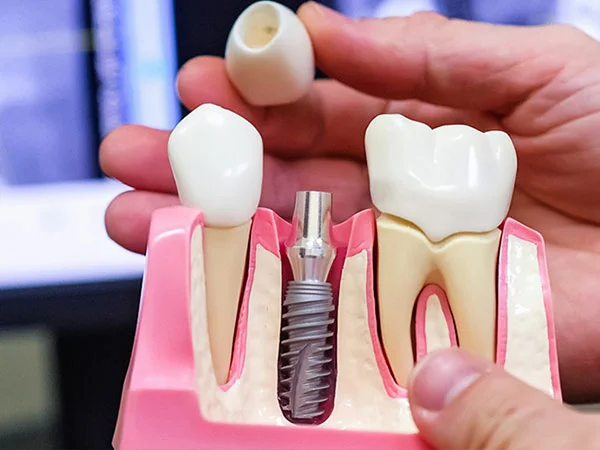 Advanced Implantology in New Delhi