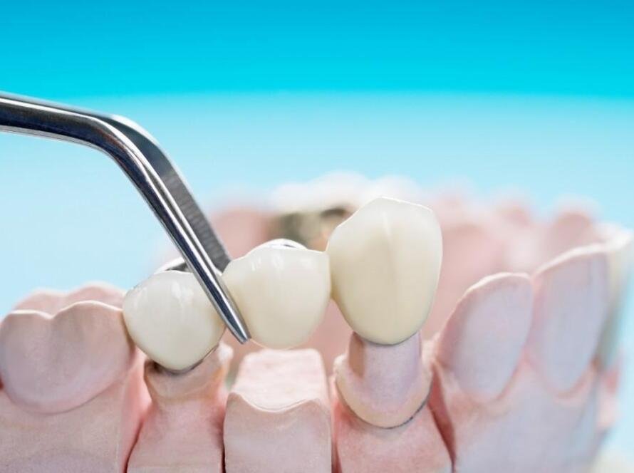 dental bridges in New Delhi