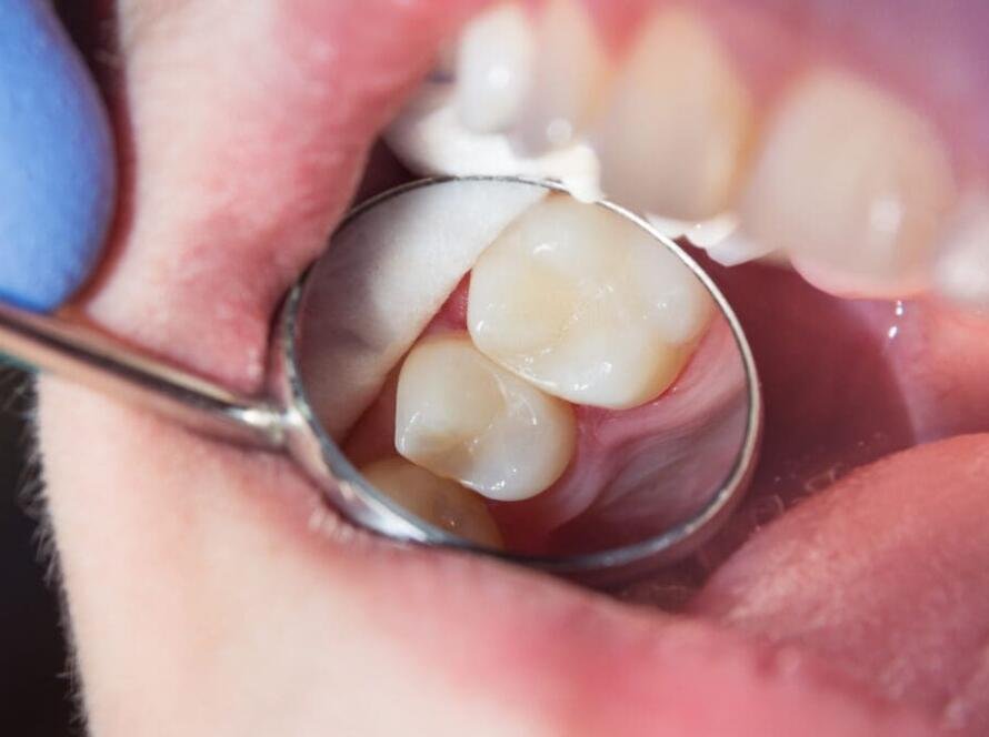 prevention of cavities in New Delhi