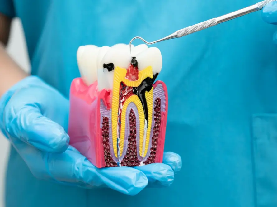 root canal treatment in New Delhi