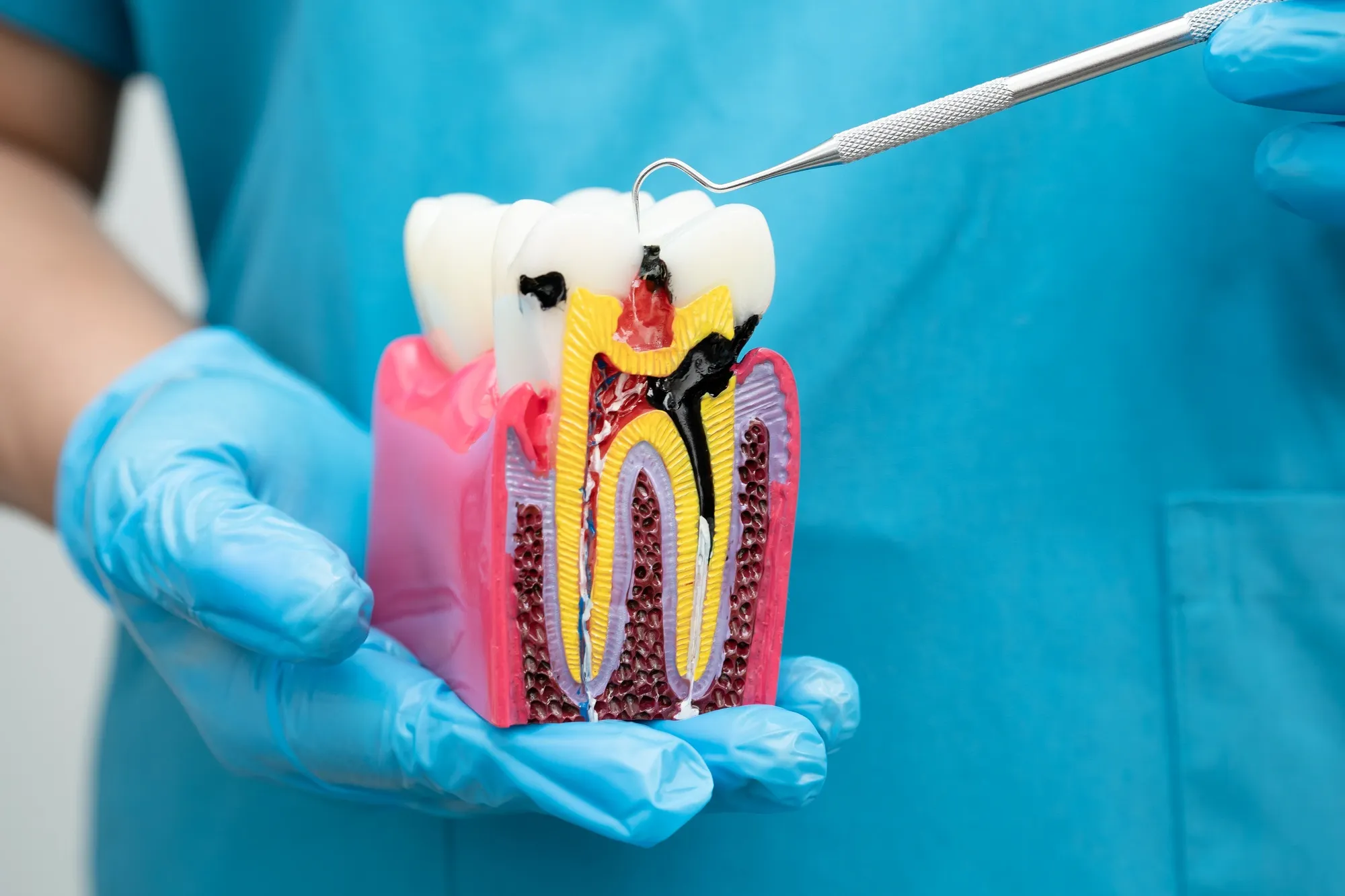 Root canal treatment