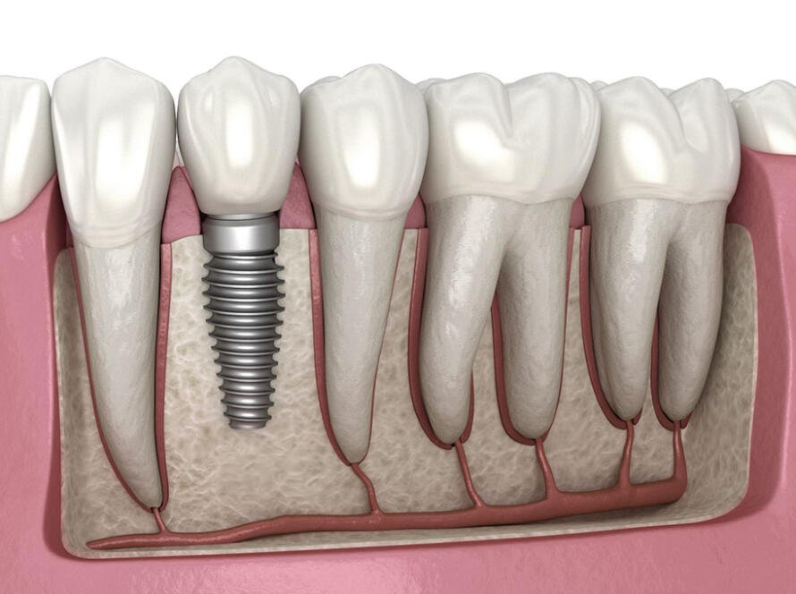 Dental-implant