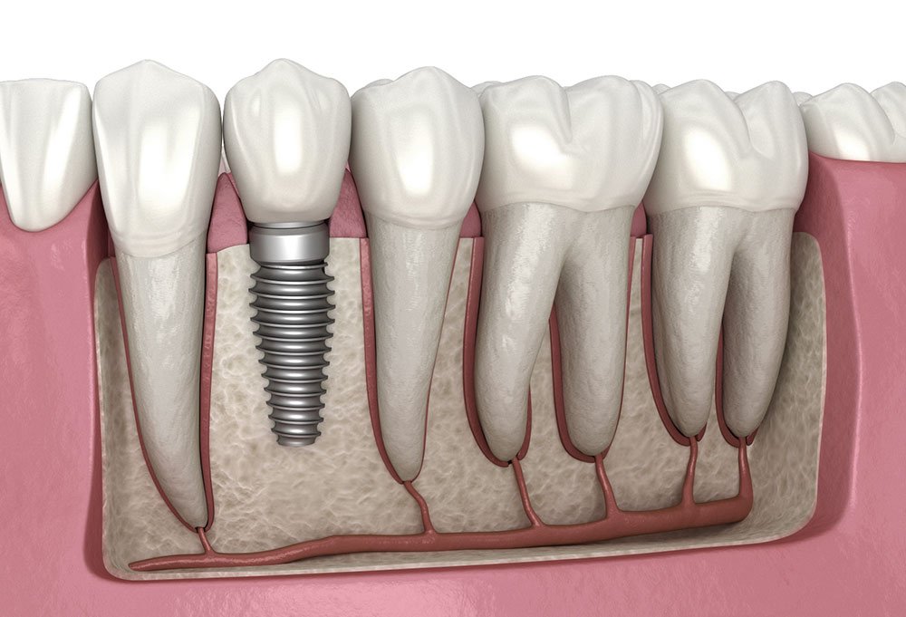 Tooth implant