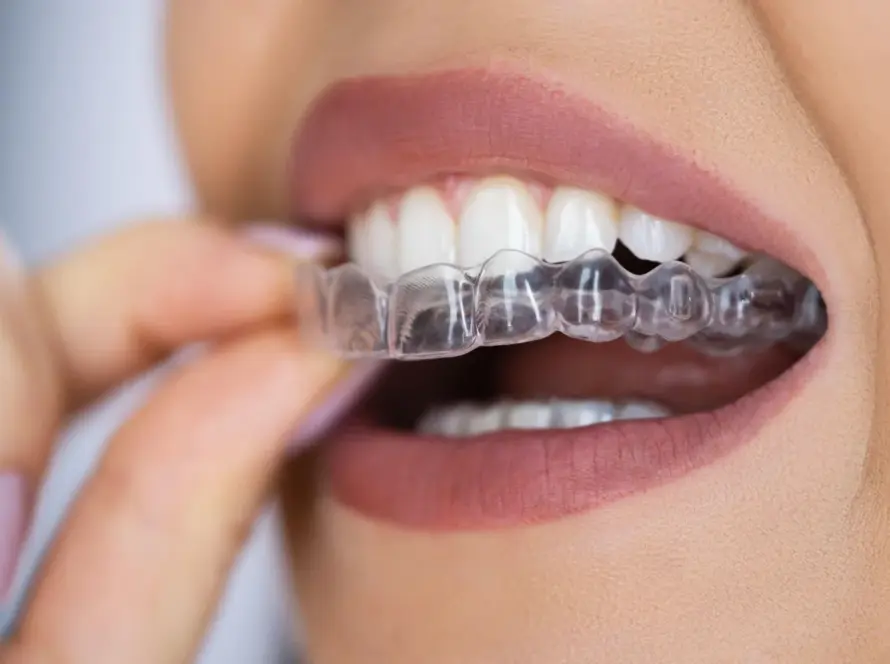Invisalign Aligners In New Delhi