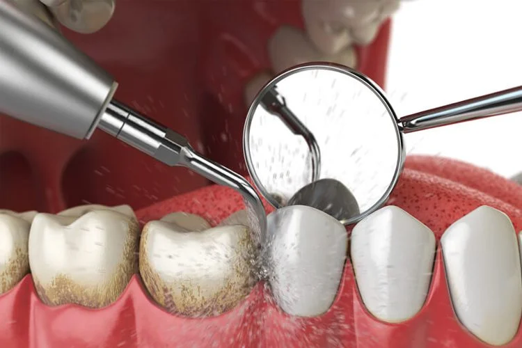 Scaling and Polishing (oral prophylaxis)