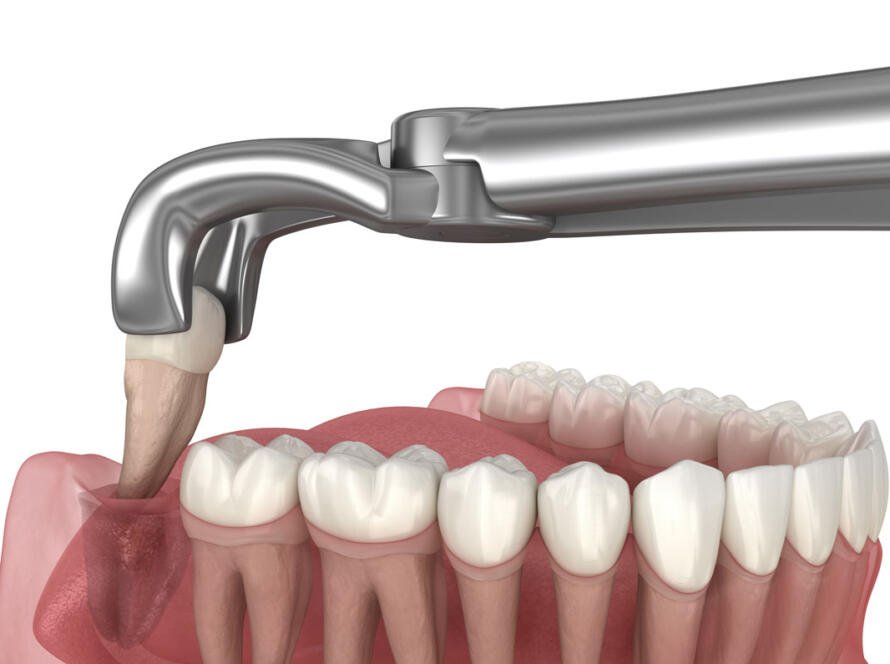 Wisdom-Tooth-Extraction-in-New-Delhi