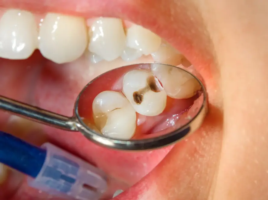 cavity care in New Delhi