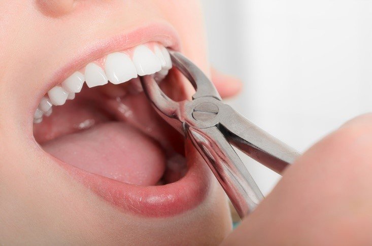 tooth extraction in New Delhi