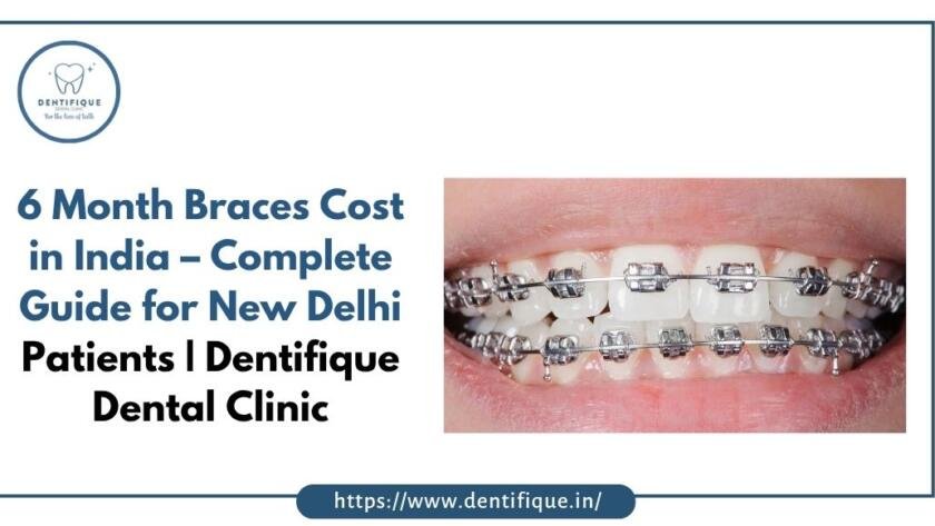 6 Month Braces Cost in India – Complete Guide for New Delhi Patients Dentifique Dental Clinic