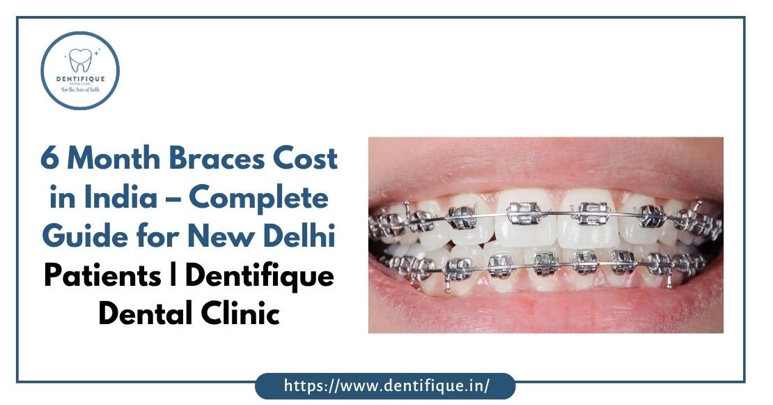 6 Month Braces Cost in India – Complete Guide for New Delhi Patients Dentifique Dental Clinic