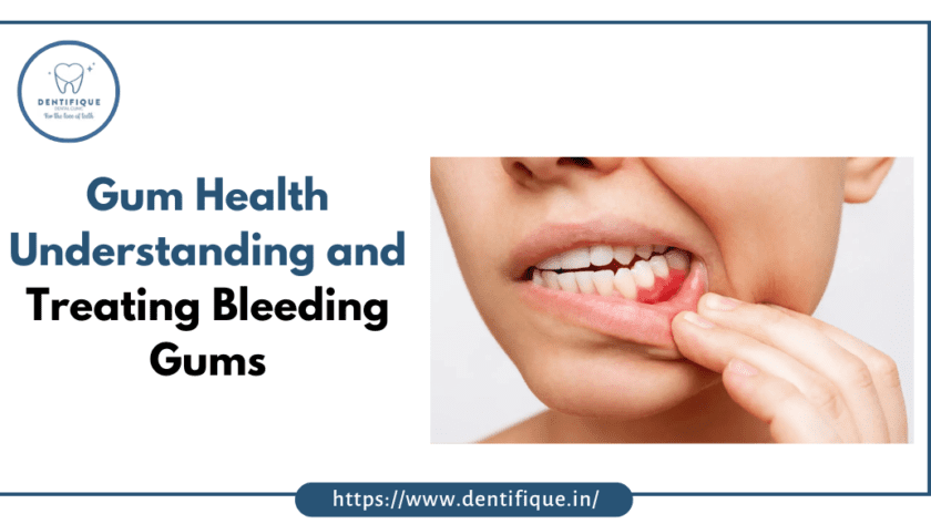 Gums bleeding