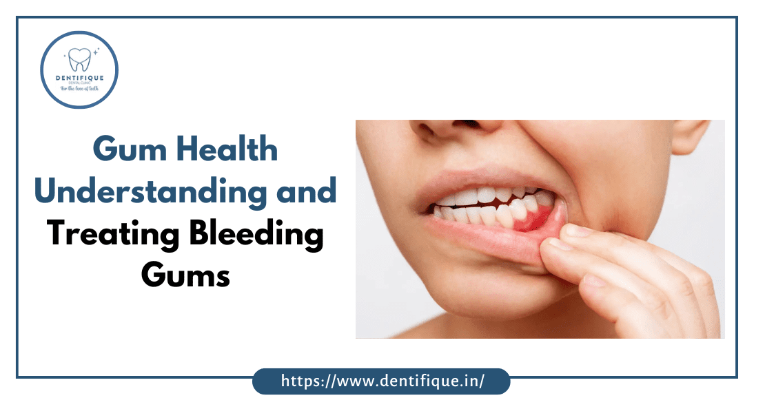 Gums bleeding